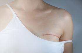 La mastectomie bilatérale